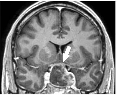 Pituitary apoplexy and COVID-19 vaccination: a case report and literature review